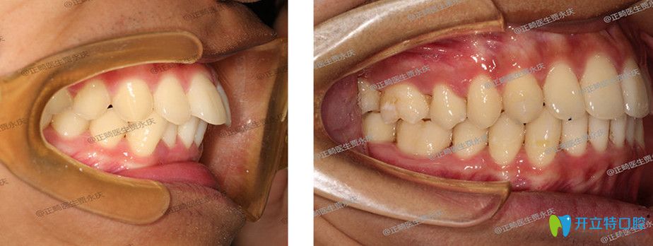 成都圣貝賈永慶牙齒矯正效果圖 成都圣貝賈永慶牙齒矯正效果圖
