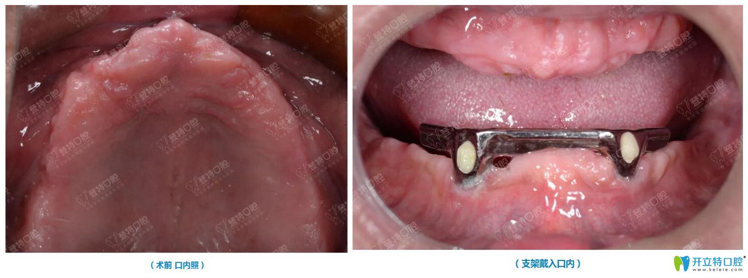 廈門(mén)種植牙牙科醫(yī)院排名前十,登特/麥芽/峰煜比較好又便宜