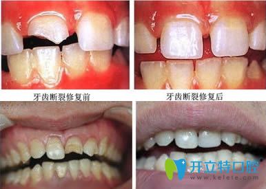 <!--<i data=20240703-sp></i>-->恒愿齒科常紅琴牙體修復案例效果對比圖 <!--<i data=20240703-sp></i>-->恒愿齒科常紅琴牙體修復案例效果對比圖