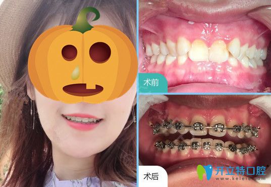 韋博口腔牙齒矯正前后變化圖 韋博口腔牙齒矯正前后變化圖