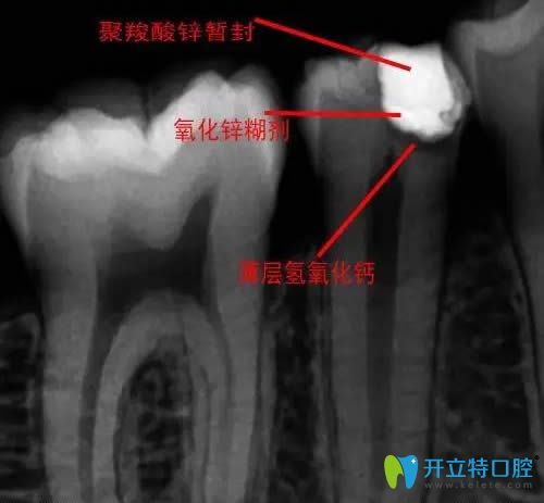 直接蓋髓術(shù)拍片圖解