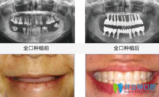 湛江致美口腔全口牙種植牙案例效果