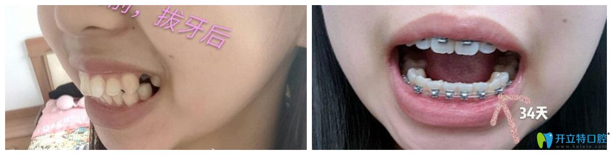 陳卓骨性齙牙矯正34天效果對比圖