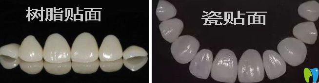 牙齒樹(shù)脂貼面和瓷貼面哪個(gè)效果好?看樹(shù)脂與瓷貼面的區(qū)別