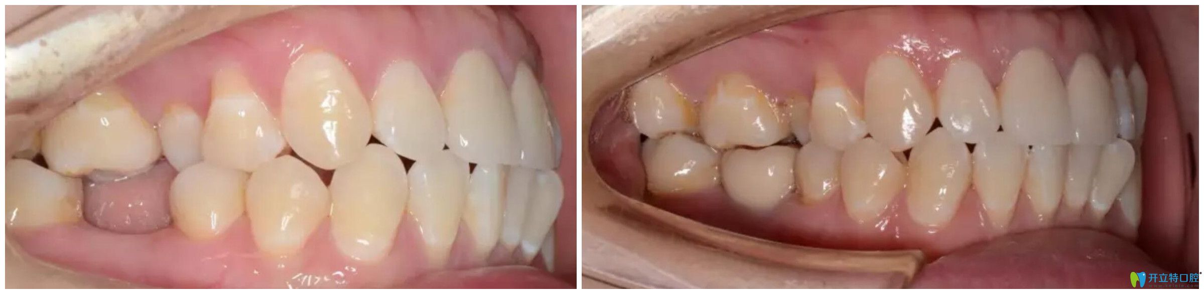 太原眾牙口腔3D無痛種植牙案例