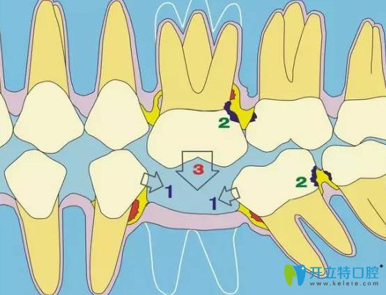 拔牙以后會導致鄰牙松動嗎