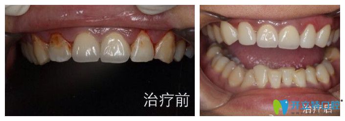 <!--<i data=20240703-sp></i>-->口腔趙中華怎么樣？來(lái)看真人案例效果