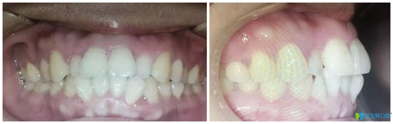 找趙中華做牙齒矯正前口腔正面、側(cè)面照