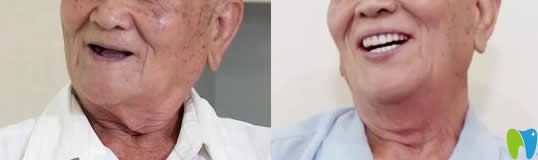 湛江致美口腔全口種植牙前后對(duì)比圖