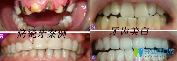 <!--<i data=20240703-sp></i>-->東奧口腔烤瓷牙和牙齒美白案例效果圖 <!--<i data=20240703-sp></i>-->東奧口腔烤瓷牙和牙齒美白案例效果圖