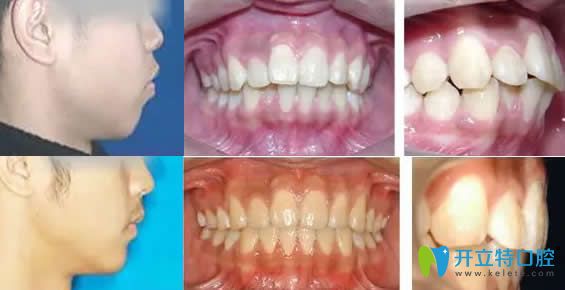 湛江致美口腔齙牙矯正前后對(duì)比圖