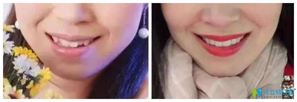 嘴突、牙齒亂 32歲在唐山北極星口腔做了金屬托槽矯正牙齒