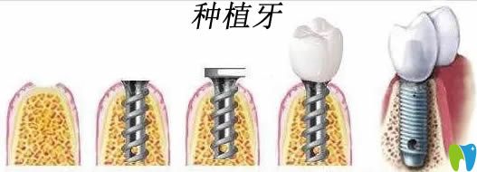種植牙國產(chǎn)好還是進口好?國產(chǎn)種植體和進口種植體區(qū)別在哪