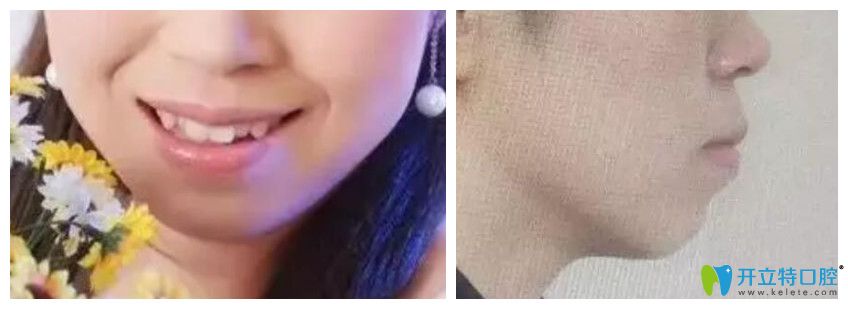 去<!--<i data=20240703-sp></i>-->口腔做牙齒矯正前正面、側(cè)面照