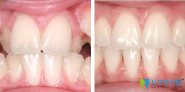 <!--<i data=20240703-sp></i>-->恒愿齒科黃鵬飛醫(yī)生牙齒矯正前后對(duì)比圖