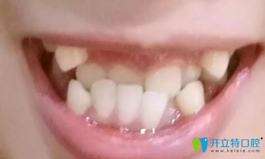 在鄭州唯美口腔正畸18個(gè)月后,分享反頜牙齒矯正經(jīng)歷和照片