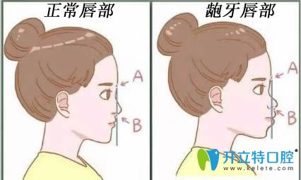 怎么區(qū)分齒性齙牙和骨性齙牙?哪個容易矯正?附相應正畸方法