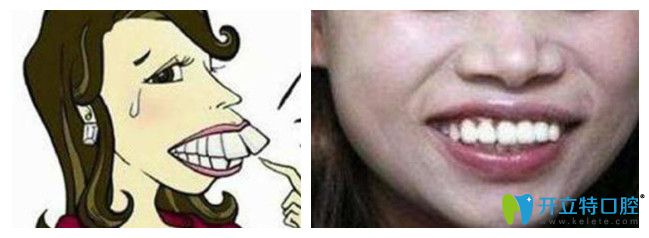 嚴重的大齙（暴）牙