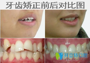 求問醫(yī)生牙齒矯正疼嗎？教你牙齒矯正疼痛怎么緩解