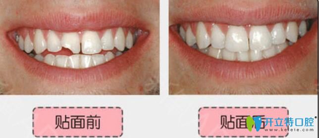 無錫北極星口腔楊亮亮怎么樣？真人案例及反饋來驗(yàn)證