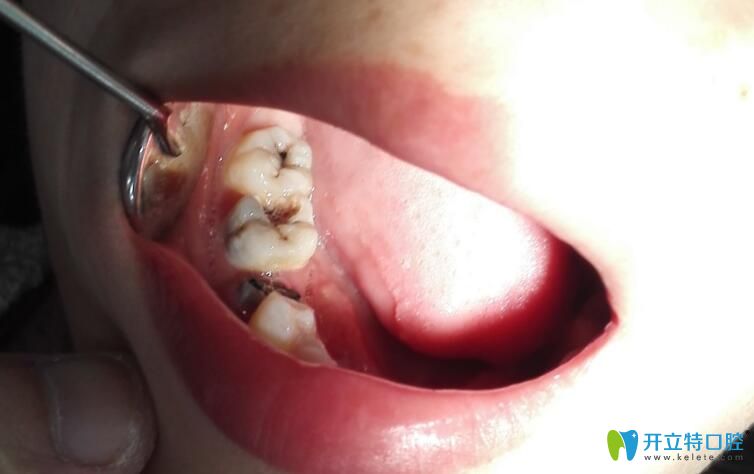 一個(gè)牙醫(yī)的良心忠告：小孩子蛀牙不僅要補(bǔ)，還要及時(shí)補(bǔ)