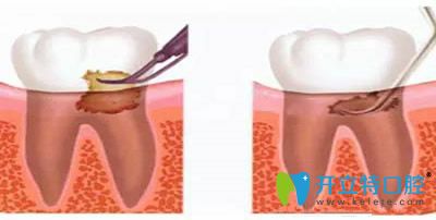 洗牙和齦下刮治可以一起做嗎？看洗牙和刮治的區(qū)別在哪里