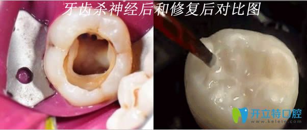牙齒殺神經(jīng)后和修復(fù)后的對(duì)比圖