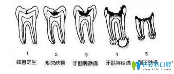 小孩子蛀牙如果不補(bǔ)可能出現(xiàn)什么情況