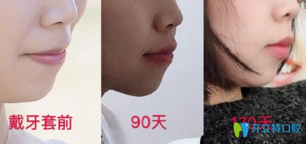 牙齒矯正能改變臉行嗎？看突嘴正畸170天臉型變化圖