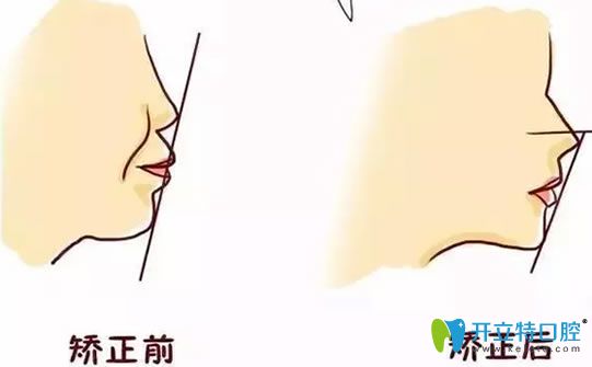 口呼吸矯正前后圖