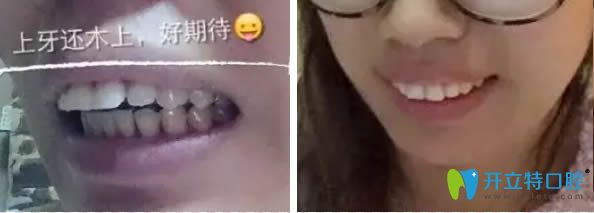 聽說長春欣雅和拜博的價格不貴,就去欣雅口腔做了舌側(cè)矯正