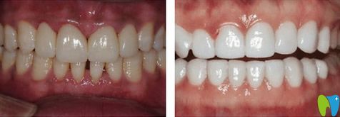 青島維樂口腔瓷貼面前后對(duì)比圖 青島維樂口腔瓷貼面前后對(duì)比圖