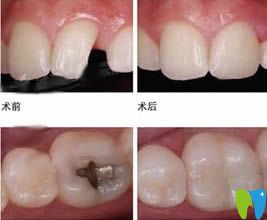 重慶牙博士口腔補牙前后對比圖