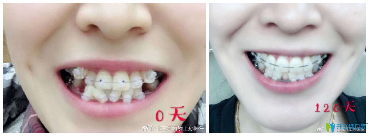 北京中諾口腔劉興華正畸怎么樣？案例效果來驗(yàn)證