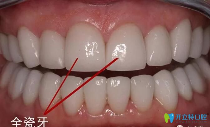 全瓷牙產(chǎn)地影響價(jià)格的，來看深圳進(jìn)口/國產(chǎn)全瓷牙多少錢一顆