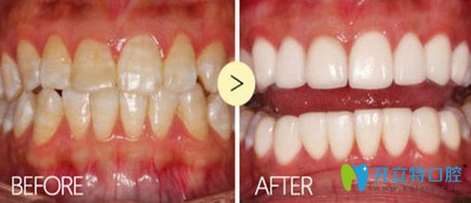 維樂口腔牙齒美白修復(fù)效果圖 維樂口腔牙齒美白修復(fù)效果圖