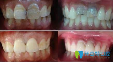 鄭州莫三心牙體修復(fù)案例效果對(duì)比圖