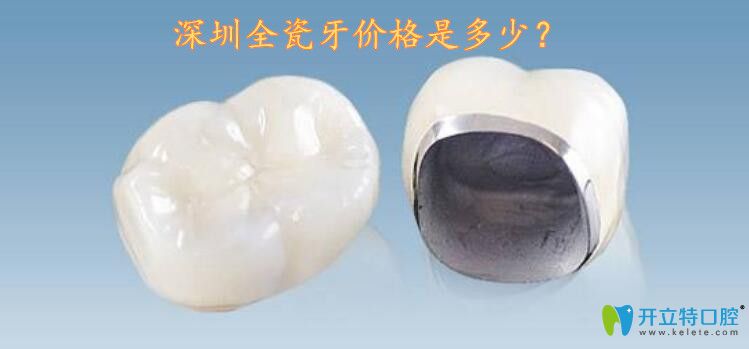 2025深圳全瓷牙價(jià)格表曝光!看完價(jià)格我驚呆了,竟然這么劃算