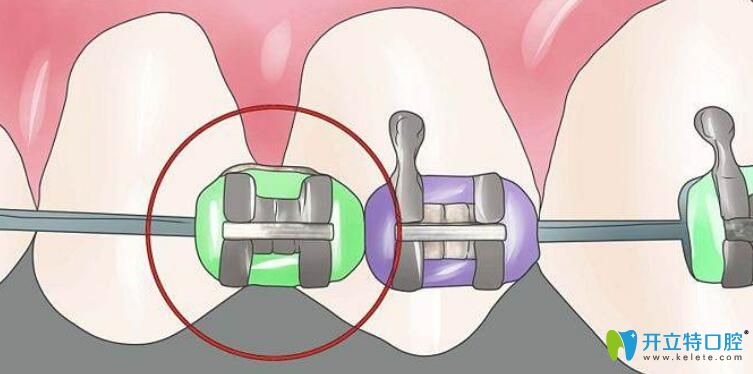 什么是自鎖托槽矯正技術(shù),價格是多少?戴自鎖矯正器過程圖解