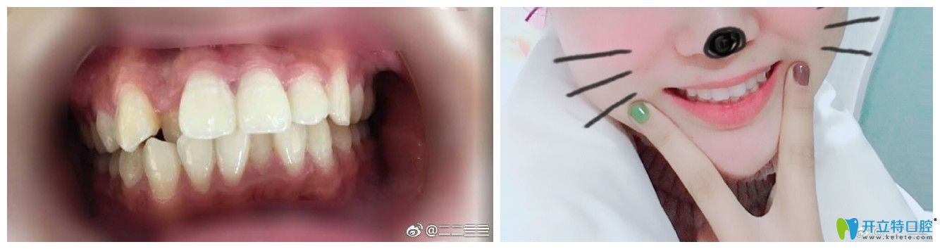 北京中諾口腔孫金鑫牙齒矯正好不好？案例效果來(lái)證明