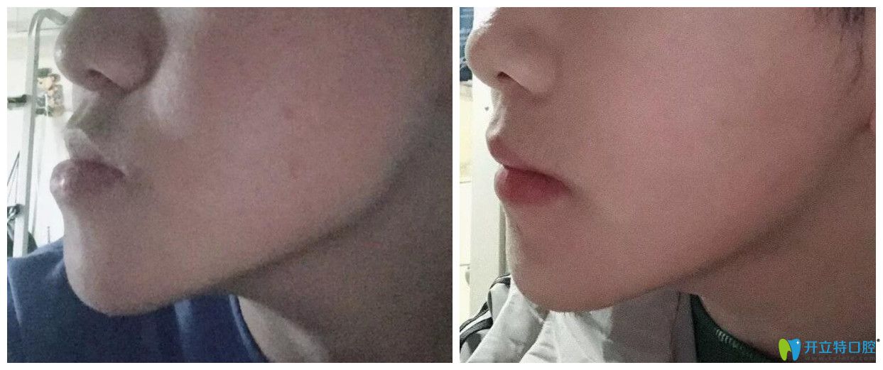 正頜手術(shù)前后對比臉型圖