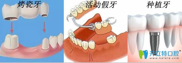 牙齒缺失10后還能做種植牙和烤瓷牙及活動(dòng)假牙嗎