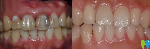 徐雅軒牙體美容案例效果對(duì)比圖