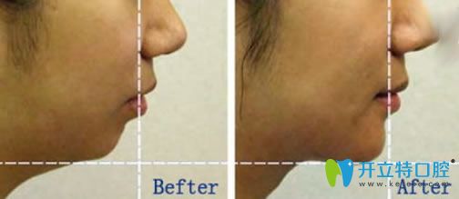 下巴后縮矯正方法