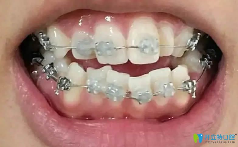 真心覺得在長春欣雅口腔做的牙齒矯正價格不貴且效果好