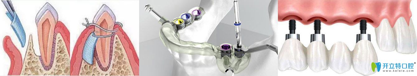 廣東圣貝孫世堯三大種植技術(shù) 廣東圣貝孫世堯三大種植技術(shù)