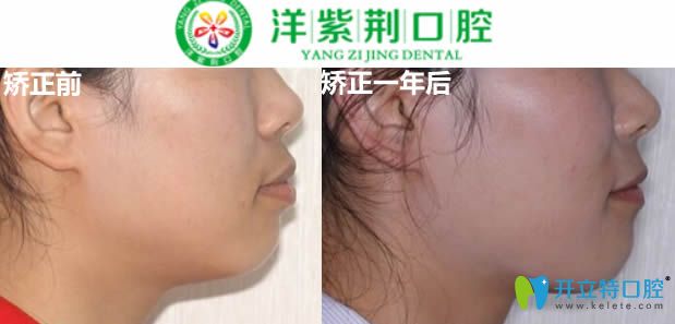 牙性齙牙選擇舌側(cè)隱形矯正后的效果