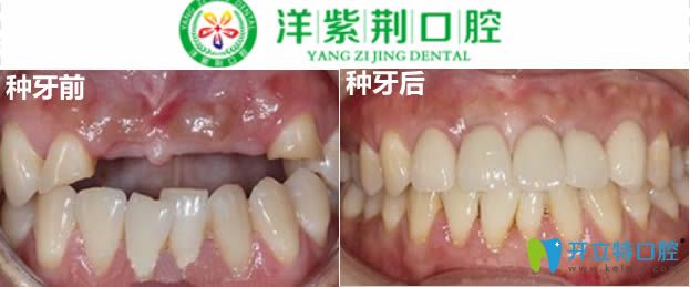 4顆門牙缺失種植修復(fù)案例圖