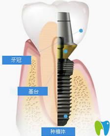 種植牙:瑞士iti和瑞典諾貝爾選哪個(gè)好?通過利弊和價(jià)格來權(quán)衡