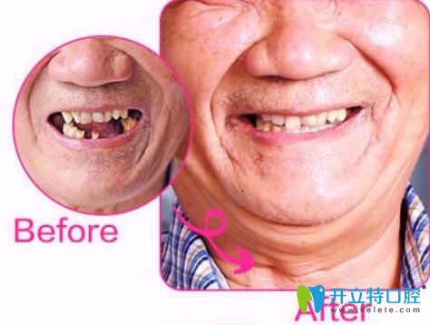 北京中諾種植牙怎么樣？郭晨剛種植牙案例來揭曉